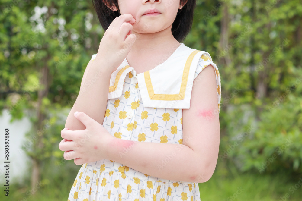 Little girl has skin rash allergy itching and scratching on her arm Little girl has skin rash allergy itching and scratching on her arm