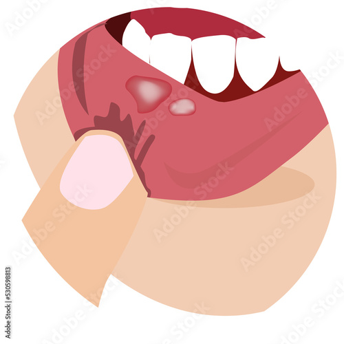 stomatitis in mouth