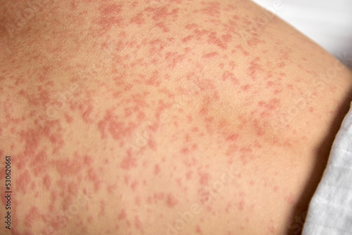Close-up of a red rash on the human body. Human skin is covered with painful red spots photo