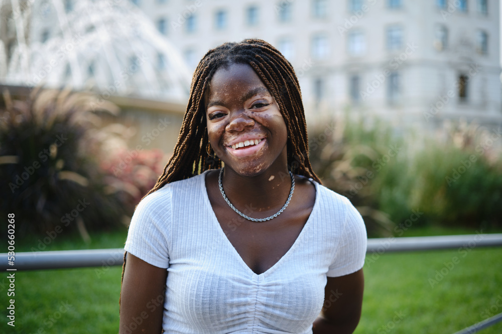 African American woman with vitiligo looking at camera and smiling while standing outdoors. African American woman with vitiligo looking at camera and smiling while standing outdoors.