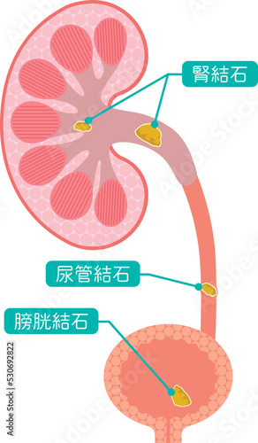 腎臓や膀胱の結石の説明イラスト