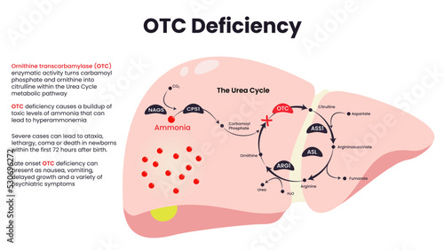 Ornithine Transcarbamylase (OTC) Deficiency diagram vector
