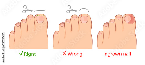correction of an ingrown toenail with titanium thread. medical illustration