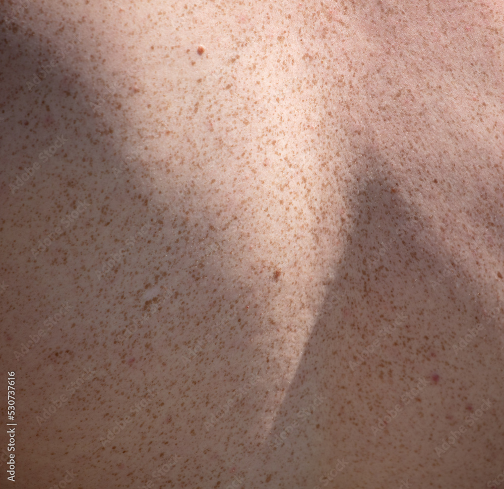 Freckle on the back of a man.