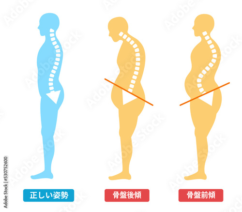 猫背と反り腰　骨盤と肥満ダイエット