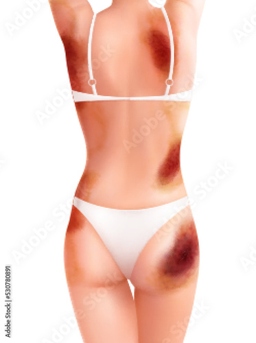 Injured Woman Body Composition