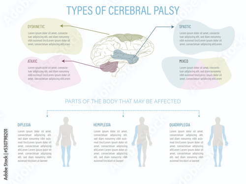 World Cerebral Palsy Day.infographic with a brain and the parts affected by the different types of paralysis as well as what part of the body is affected by each type.