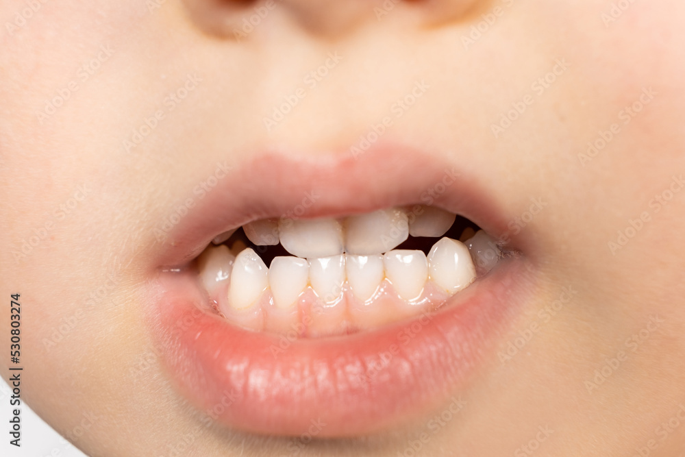 Obraz premium Milk teeth of a five-year-old child - bite, plaque on the teeth, hygiene and care.