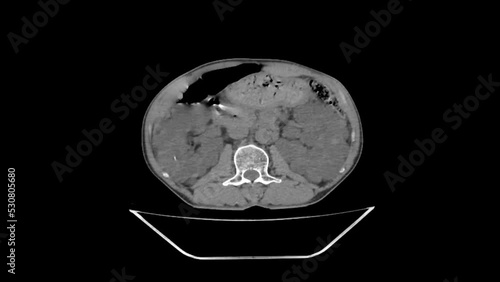 Autosomal dominant polycystic kidney disease (ADPKD), abdomen CT scan 
 photo