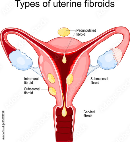 Uterine fibroids photo