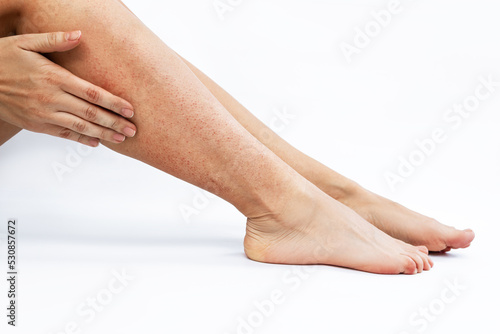 Irritation and redness on sensitive skin after epilation. Cropped shot of a young woman touching her legs with her hand after depilation isolated on a white background. Hair removal with wax, epilator photo