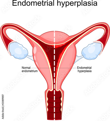 Endometrial hyperplasia photo