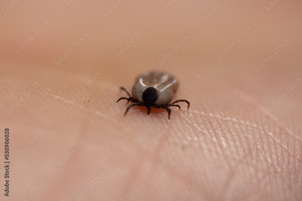 Tick filled with blood sitting on human hand skin. Ixodes ricinus or scapularis. Close-up of dangerous parasitic mite in dynamic motion. Diseases transmission as encephalitis. Macro photography Tick filled with blood sitting on human hand skin. Ixodes ricinus or scapularis. Close-up of dangerous parasitic mite in dynamic motion. Diseases transmission as encephalitis. Macro photography