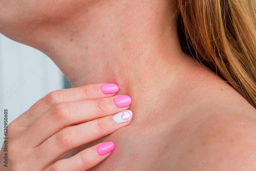 Allergic dermatitis on skin of woman's neck. Skin disease