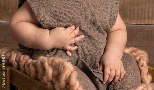 Polydactyly baby hand genetic condition