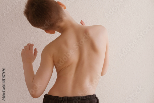 Canvas Print naked back of boy, child 8-10 years old grabbed a sore spot, curved spine, pain