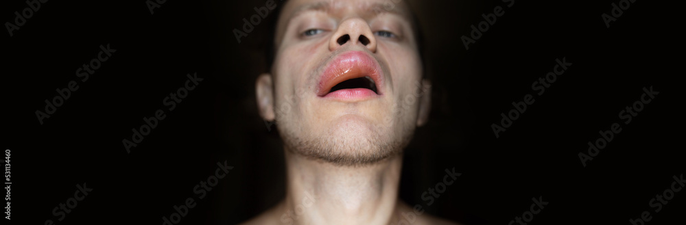 plump lips, allergic reaction of angioedema in a man on the lip. The concept of lip augmentation, cheiloplasty - lipofilling and botox injections plump lips, allergic reaction of angioedema in a man on the lip. The concept of lip augmentation, cheiloplasty - lipofilling and botox injections