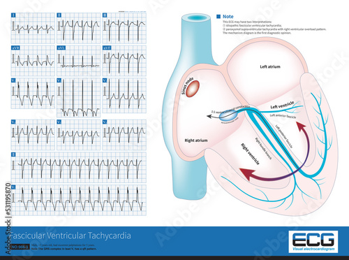 Billede på lærred A fascicular ventricular tachycardia is an idiopathic ventricular tachycardia that originates in the left fascicular region, in this case the left posterior fascicular region