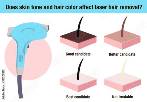 Does skin tone and hair color affect laser hair removal. Hair removal laser icon vector illustration. Flat vector hair removal equipment. Cosmetology Salon Diagram. Epilation and cosmetology