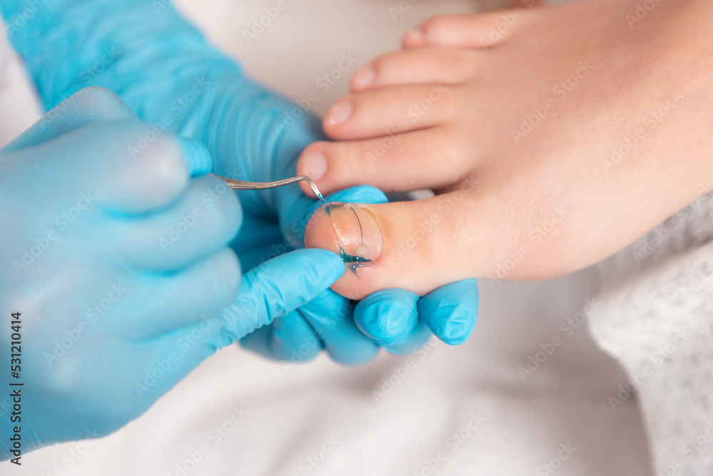 A podologist in blue gloves cleans a toenail with titanium thread. Close-up. The concept of podology and chiropody A podologist in blue gloves cleans a toenail with titanium thread. Close-up. The concept of podology and chiropody