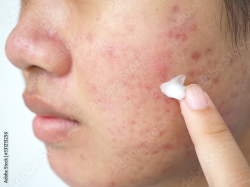 Teenager face with acne inflammation (Papule and Pustule) on her face and she applying acne cream on her face for treat. Concept of problems on woman skin. Closeup photo, blurred.