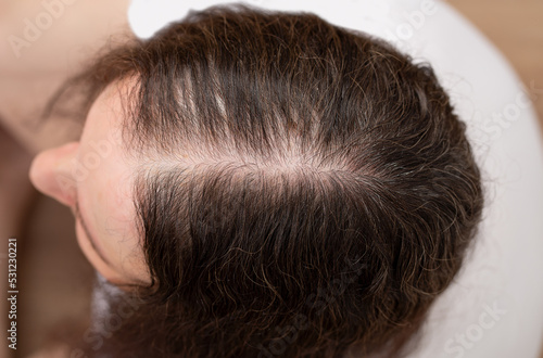 Top view of a woman with hair loss and no volume photo