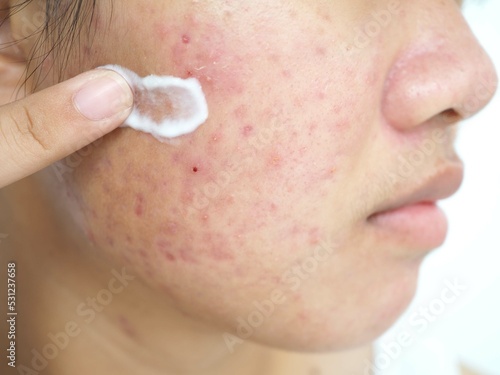 Skin care concept. Young woman applying acne treatment cream, Closeup photo, blurred.