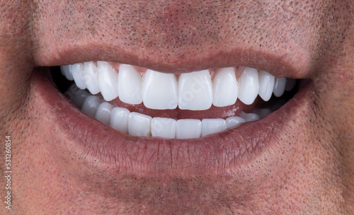 dental job photography, crowns veneers implants