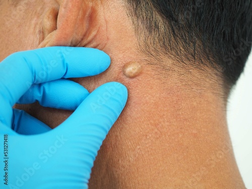 Man pointed to sebaceous cysts on his neck, formed by sebaceous glands. Oils called sebum and laser skin treatments or flea biopsies health concept. closeup photo, blurred.