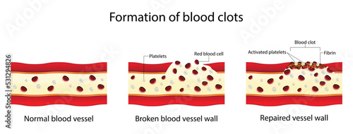 illustration of Biology and medical, Formation of blood clots, Blood clotting normally occurs when there is damage to a blood vessel, A platelet plug is formed, and the external bleeding stops