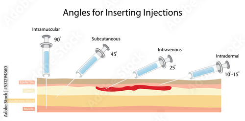 illustration of biology and medical, Angles for inserting injections, Simple drawing of cross section of skin with three needles administering injections at different angles,  injection sites