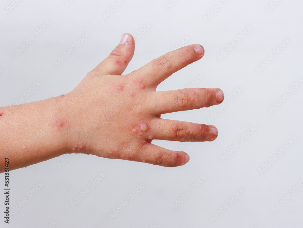 red rash on baby hands Handfootandmouth disease HFMD Stock Photo