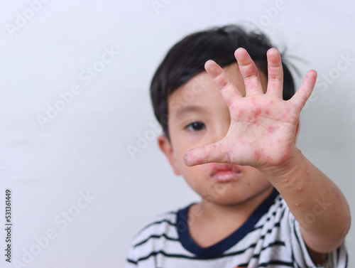 Boy suffering from hand, foot and mouth disease showing hand with rash photo