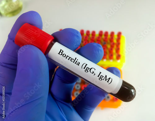 Scientist holding blood sample tube for Borrelia IgG and IgM test, Lyme disease diagnosis. photo