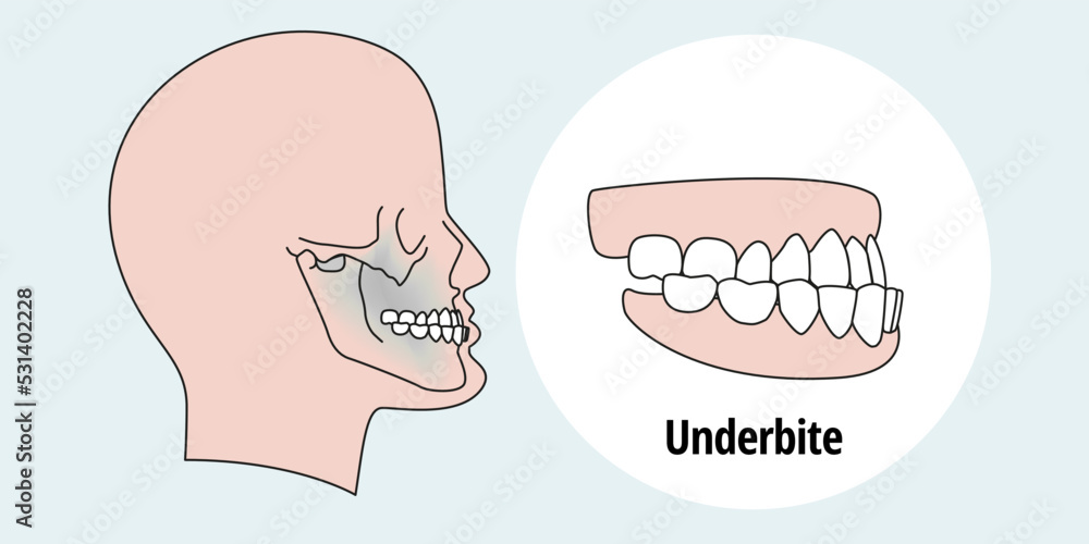 Tooth problem. Side view man with misaligned teeth. Malocclusion Tooth problem. Side view man with misaligned teeth. Malocclusion