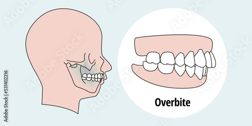 Side view of man after orthodontic treatment, right teeth aligned photo