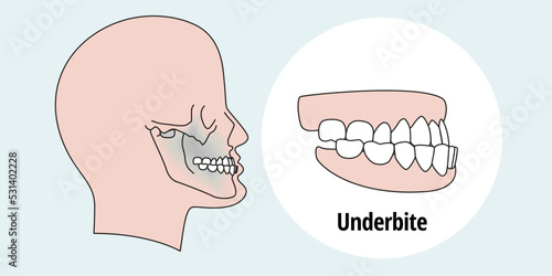 Tooth problem. Side view man with misaligned teeth. Malocclusion
