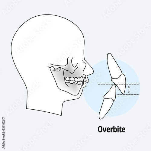 Tooth problem. side view man with misaligned teeth. malocclusion