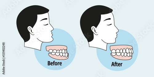 Before and after dental problem. Side view of man with misaligned teeth. Malocclusion photo