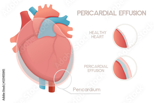 Unhealthy human heart with pericarditis disease anatomy illustration health problem vector illustration on white background photo