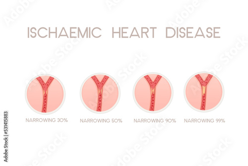 Unhealthy human heart with ischemic disease anatomy illustration health problem vector illustration on white background
