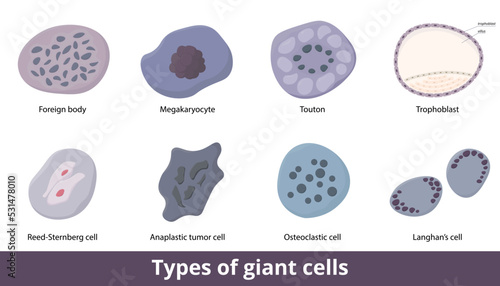 Types of giant cells. Eight types of giant cells include Langhan's, foreign body, Reed-Sternberg cell, different tumor cells, and trophoblast. Normal and inflammatory giant cell. photo