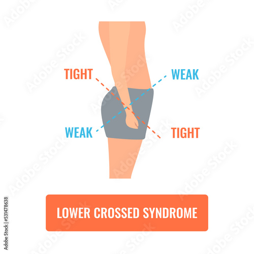 Lower crossed syndrome medical diagram. Crooked man with muscle strength imbalance. Weak and overactive pelvis muscles therapy. Incorrect spine curvature caused by bad posture. Vector illustration.