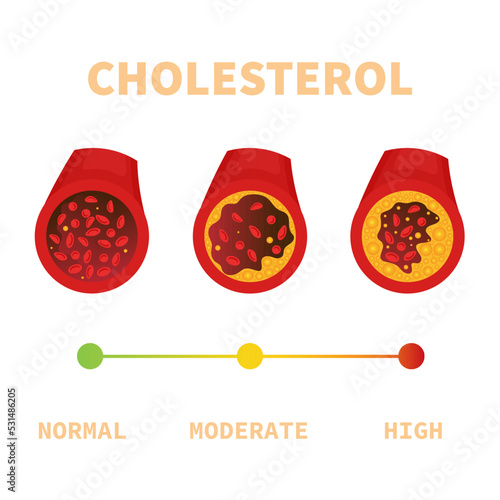 Cholesterol plaque in blocked blood vessel medical diagram. ldl and hdl lipoprotein in artery. Atherosclerosis stages test indicator. Thrombus risk. Healthcare concept. Vector illustration.