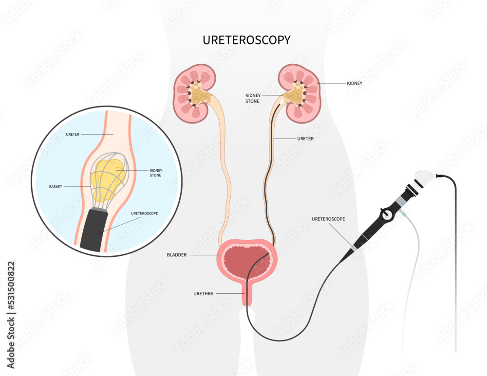 Stockvector Kidney stone removal uric acid Blocked ureter Painful