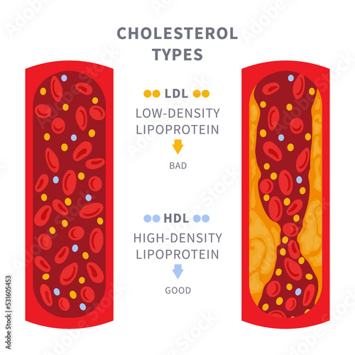 Healthy and narrowed blood vessel with cholesterol plaque buildup. Artery blocked with a fat cells clot. ldl and hdl lipoprotein comparison. Cross section medical diagram. Vector illustration.