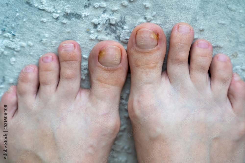 person feet close up, fungus, broken nail, skin infection, toe mycosis