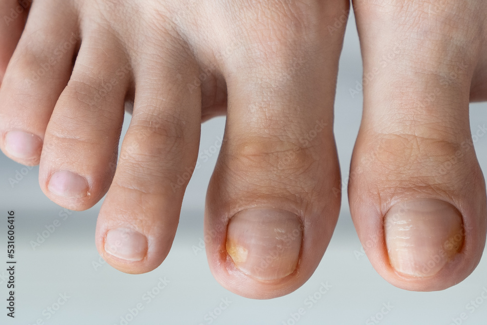 person feet close up, fungus, broken nail, skin infection, toe mycosis