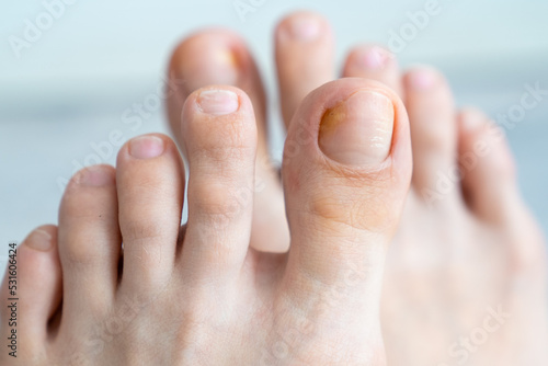 Принти на полотні person feet close up, fungus, broken nail, skin infection, toe mycosis, treatmen