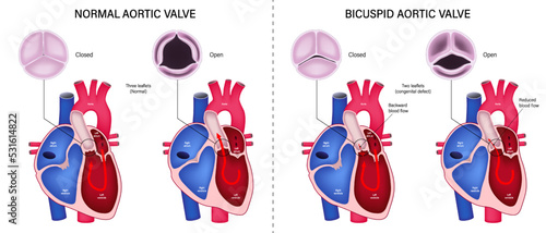 The difference of normal aortic valve and bicuspid aortic valve. Valvular aortic stenosis. Heart anatomy vector. Close-up of normal and abnormal aortic valves. photo